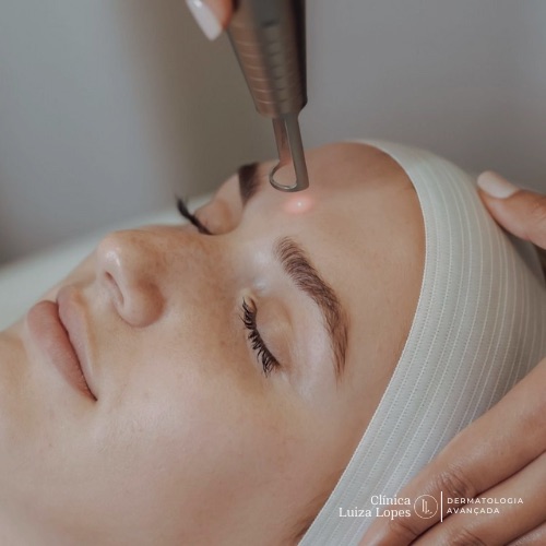 Laser facial